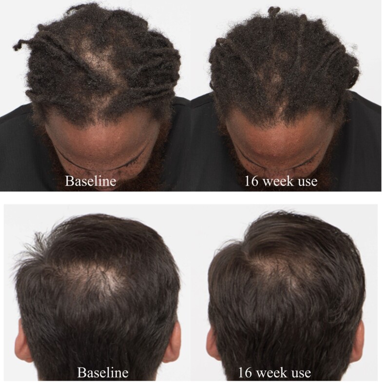 влияние серы (МСМ) на рост волос